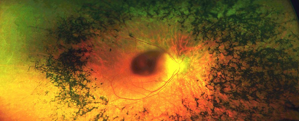 Damaged retina